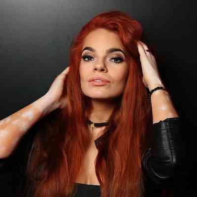 Jana Vitiligo